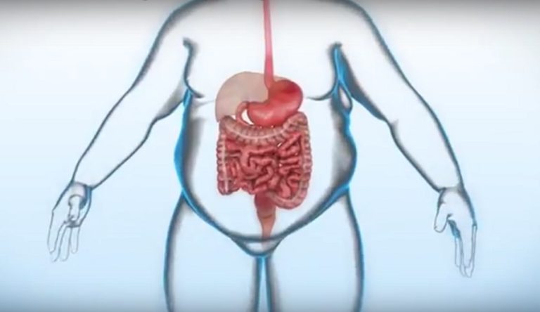 Médicos do Estado fazem cirurgia inédita para emagrecer