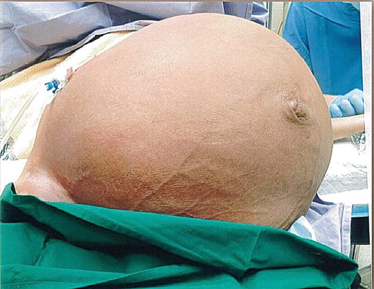 Tumor de 27 kg é retirado do útero de paciente