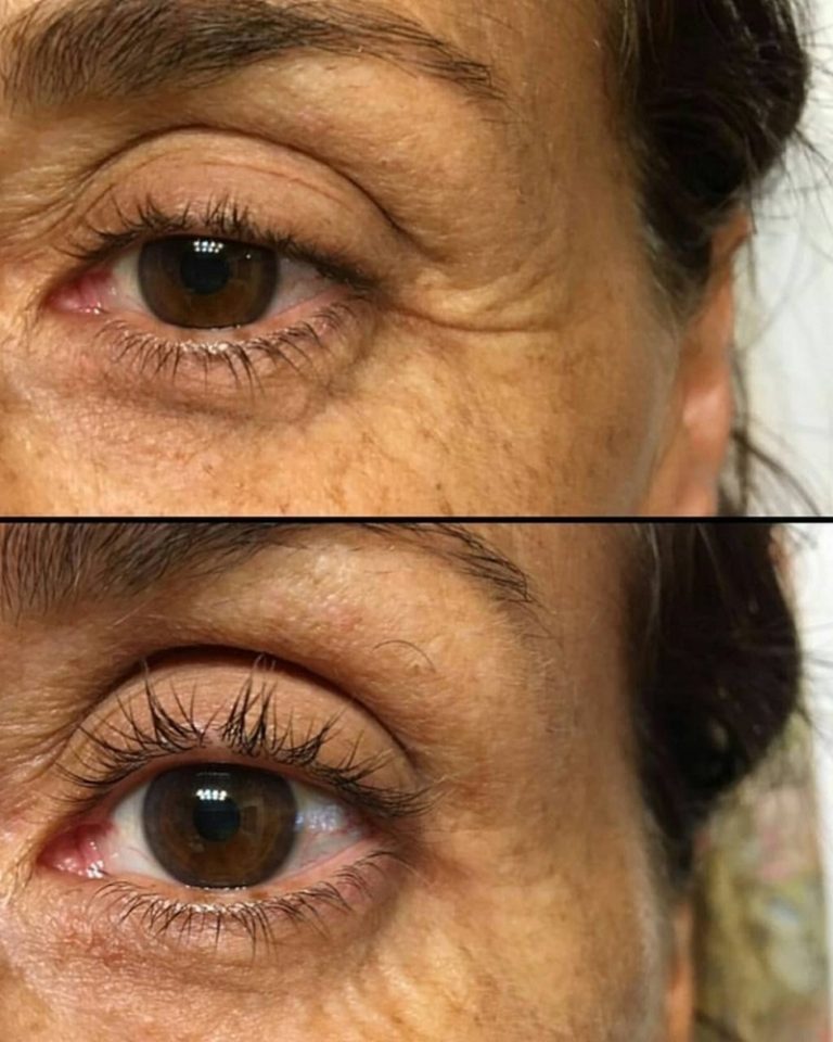Blefaroplastia: pálpebra mais jovem sem cortes
