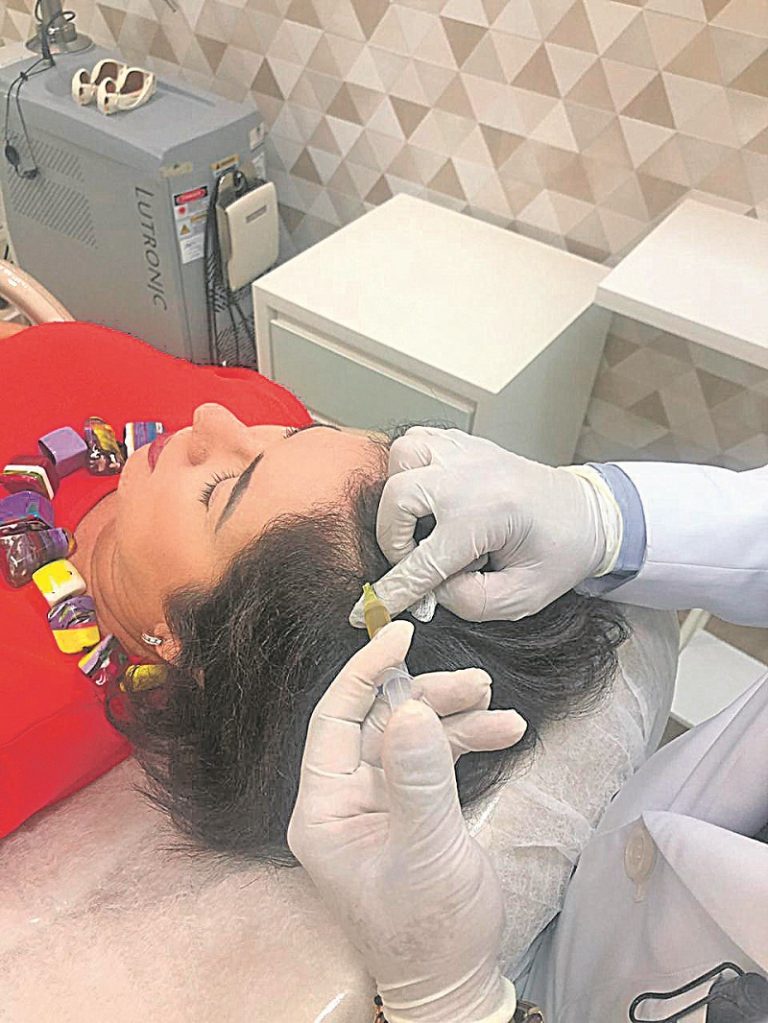 Injeção de sangue para tratar calvície