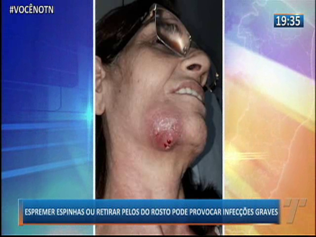 Espremer espinhas ou retirar pelos do rosto pode provocar infecções graves