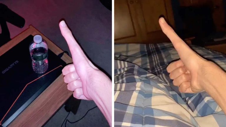 Jovem com polegar de 13 centímetros viraliza na web
