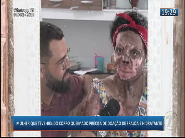Mulher que teve 40% do corpo queimado precisa de doação de fralda e hidratante