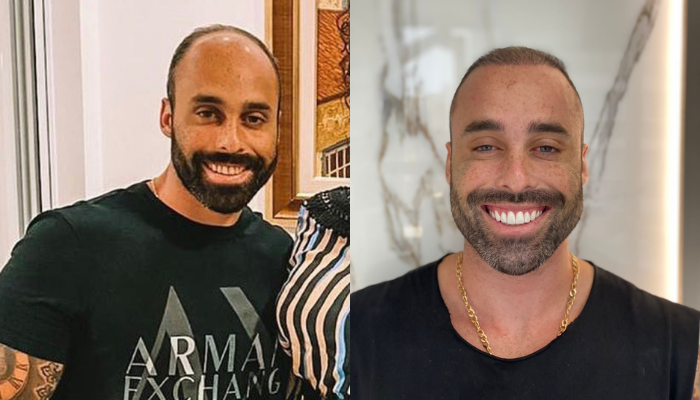 Homens procuram especialistas para mudar formato do rosto