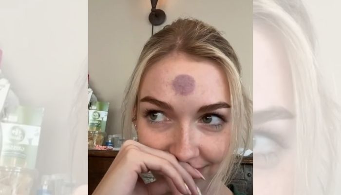 Influenciadora fica com hematoma após grudar objeto erótico na testa
