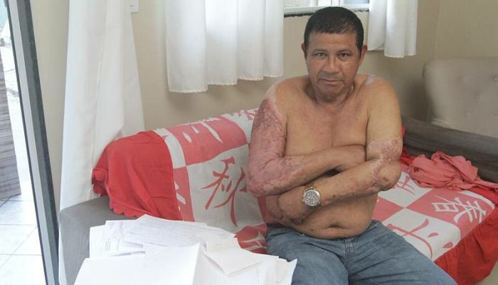 “Falaram que eu teria de amputar o braço”, diz aposentado