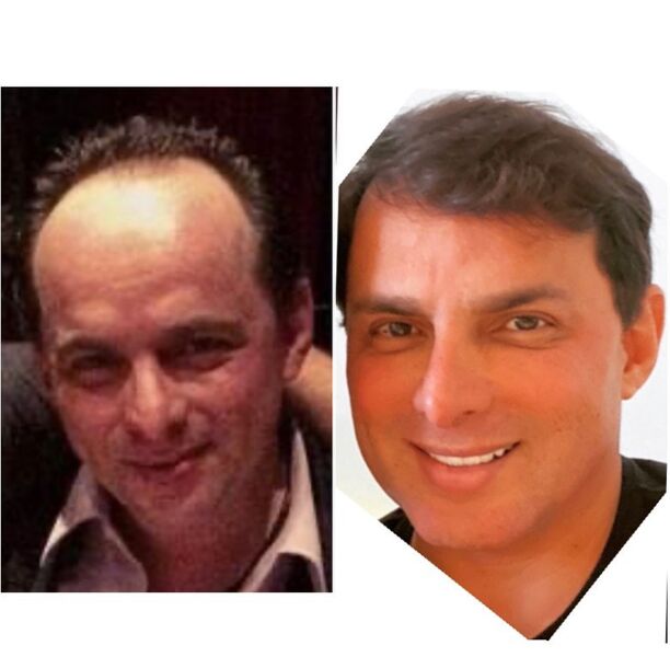 Marido de Gretchen surpreende ao mostrar antes e depois da harmonização facial