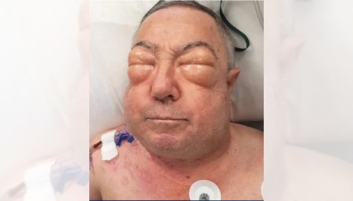 Idoso sofre complicação após cirurgia e fica com rosto desfigurado