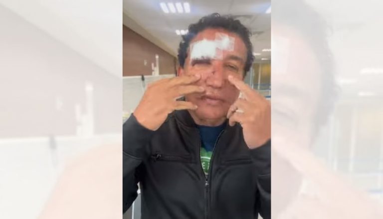 Magno Malta aparece machucado e diz que sofreu acidente em hotel
