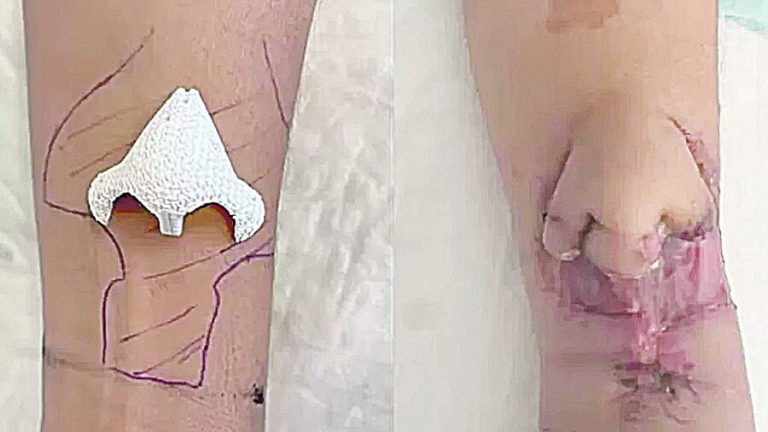 Nariz “cultivado” em braço de paciente após luta contra o câncer