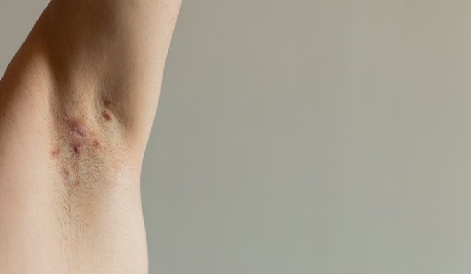 Saiba o que é a hidradenite supurativa e quais os fatores de risco