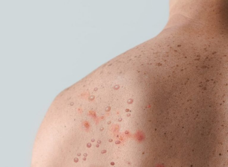 ES vai receber doses da vacina contra a nova varíola na próxima semana