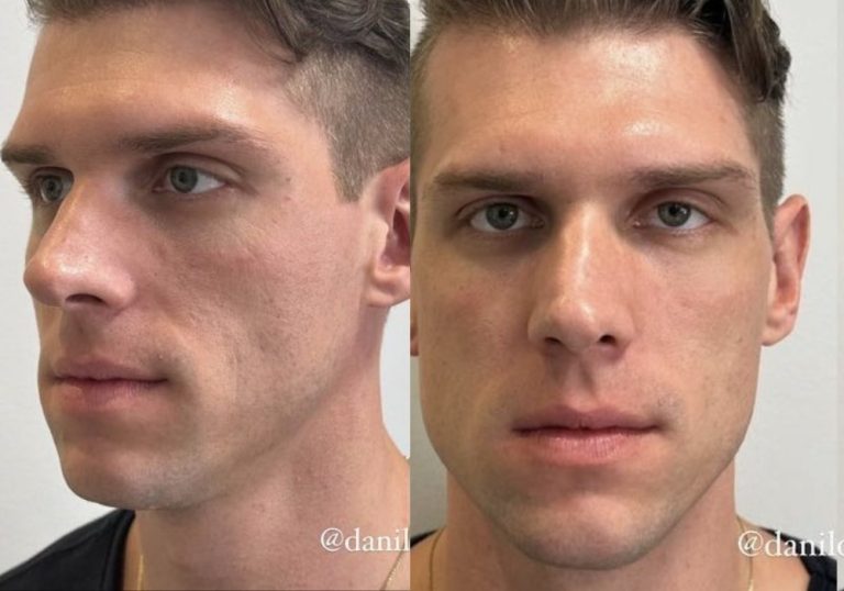 Cristian Vanelli, ex-BBB 23, gasta R$ 20 mil em harmonização facial