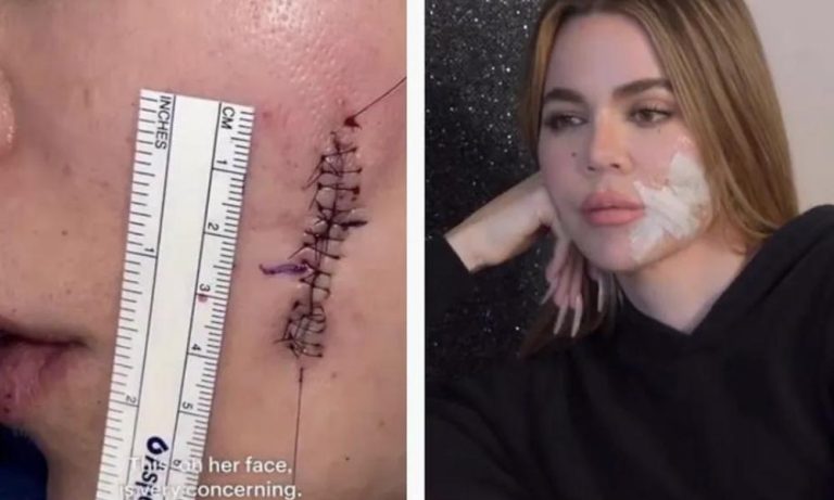 Khloé Kardashian mostra cicatriz no rosto após cirurgia e ganha elogios