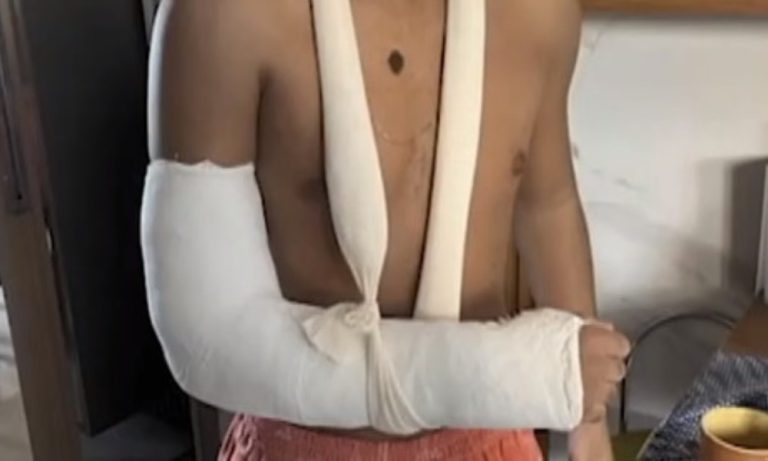 Adolescente quebra o pulso após encostar em corrimão de ponte e levar choque
