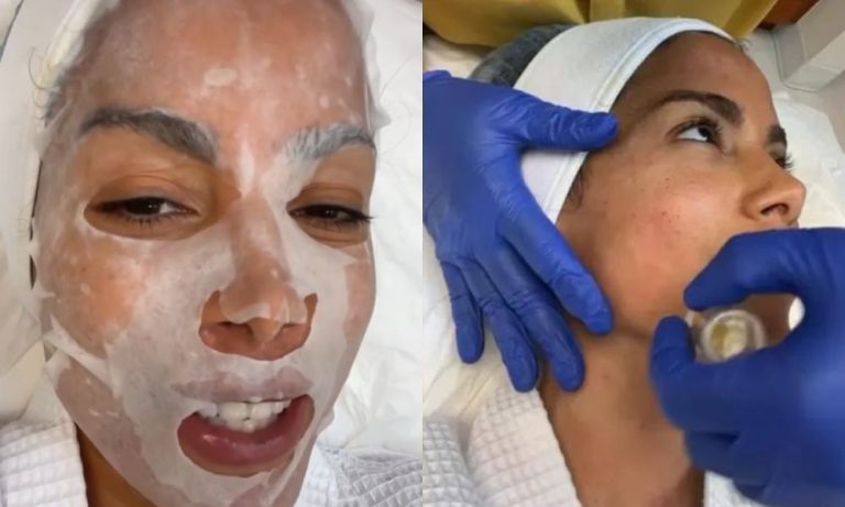 Anitta exibe detalhes de tratamento estético com o próprio sangue