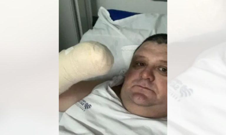 Humorista tem mão amputada após acidente com fogos de artifício em SC