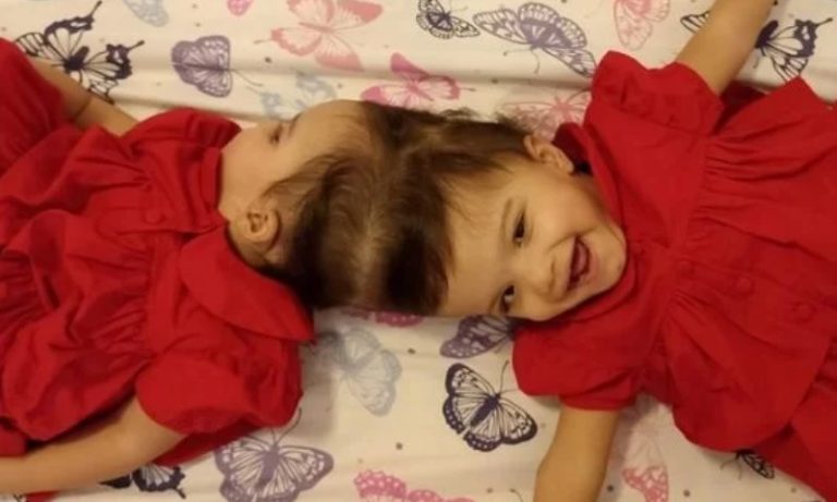 Gêmeas siamesas passam bem um dia após a cirurgia de separação