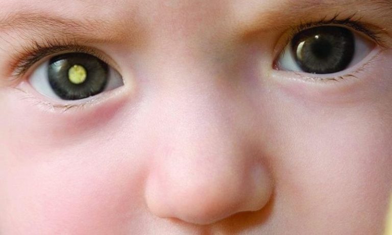 Olho de gato em criança é alerta de tumor ocular maligno