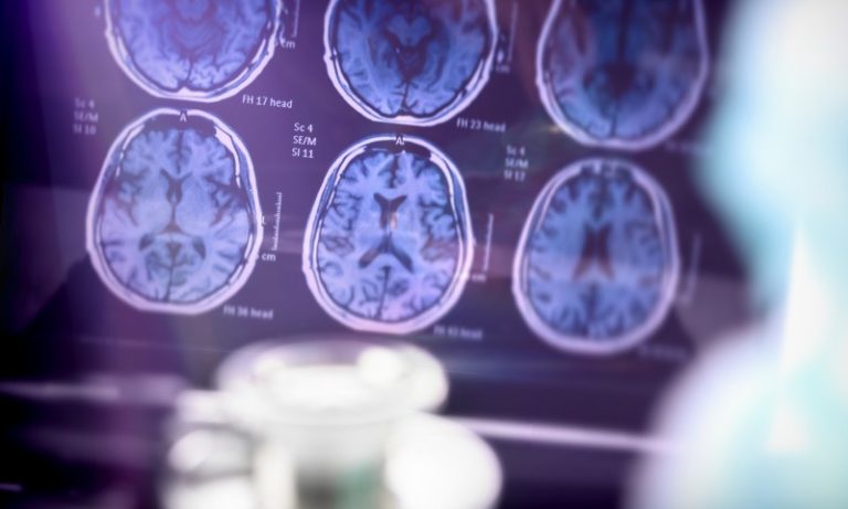 Novas drogas contra Alzheimer são avanço no tratamento, dizem especialistas
