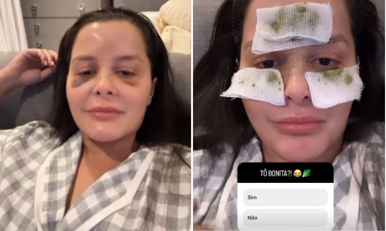 Após quebrar o nariz, Maraisa mostra hematomas no rosto e brinca: ‘Estou bonita?’