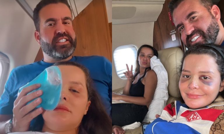 Maraisa mostra hematomas no rosto após acidente em piscina de resort