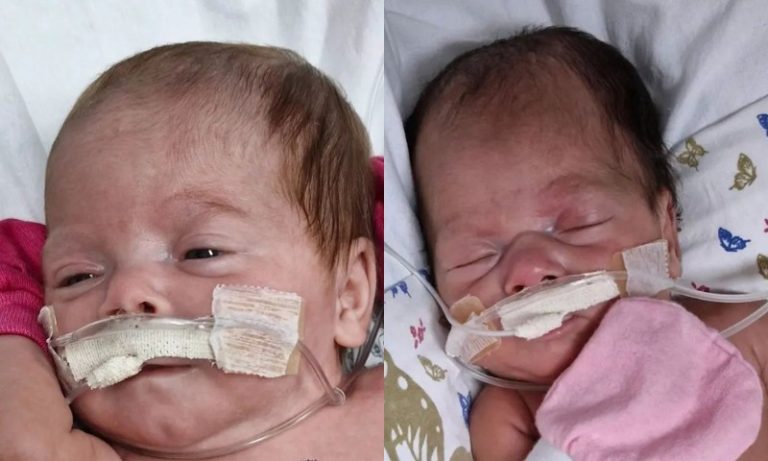 Gêmeos de Colatina: Eloá e Maytê vão receber alta do hospital nesta quarta-feira