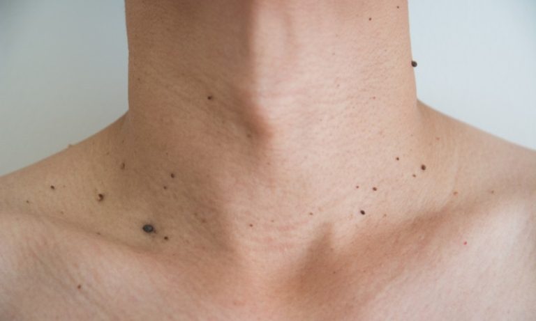 Médico diz quando pintas no corpo devem preocupar