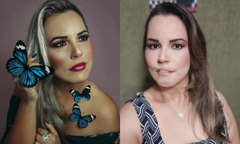 Mulher perde o lábio superior após fazer preenchimento com PMMA