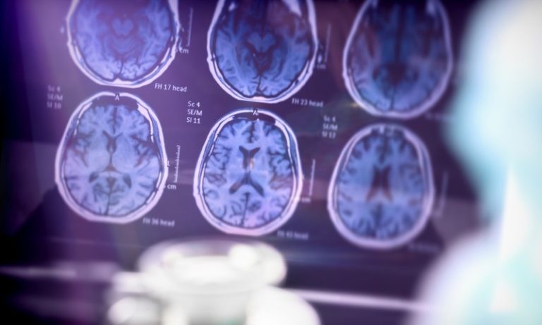 Descobertas sobre o Alzheimer dão mais esperança a pacientes