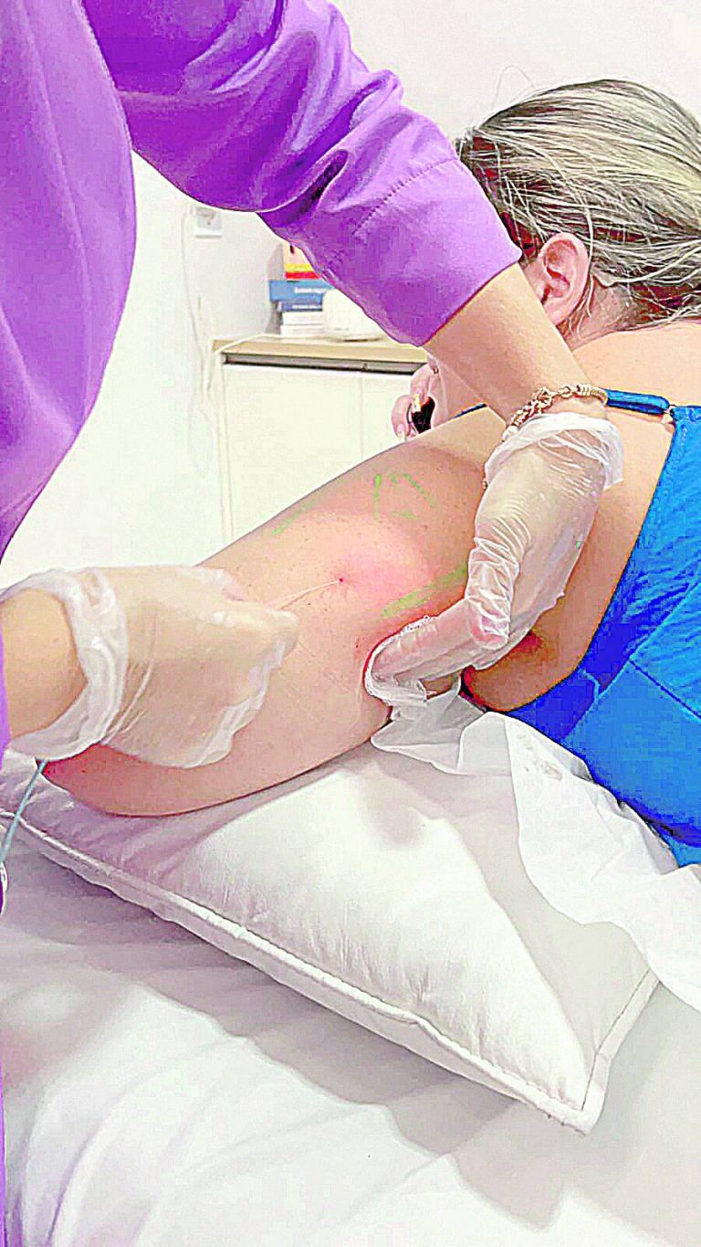 Recuperação mais rápida e sem bisturi