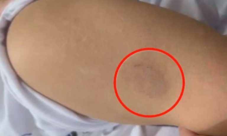 Cuidadora é demitida de creche após morder criança no Sul do ES
