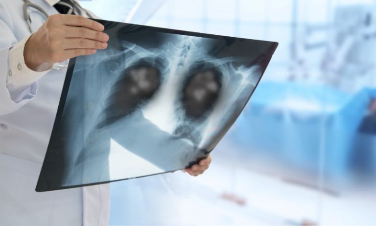 Pneumonia: hospitais têm alta de casos, incluindo tipo “silencioso”. Veja sintomas