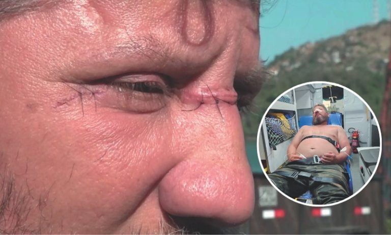 Motociclista é ferido por linha com cerol na Segunda Ponte