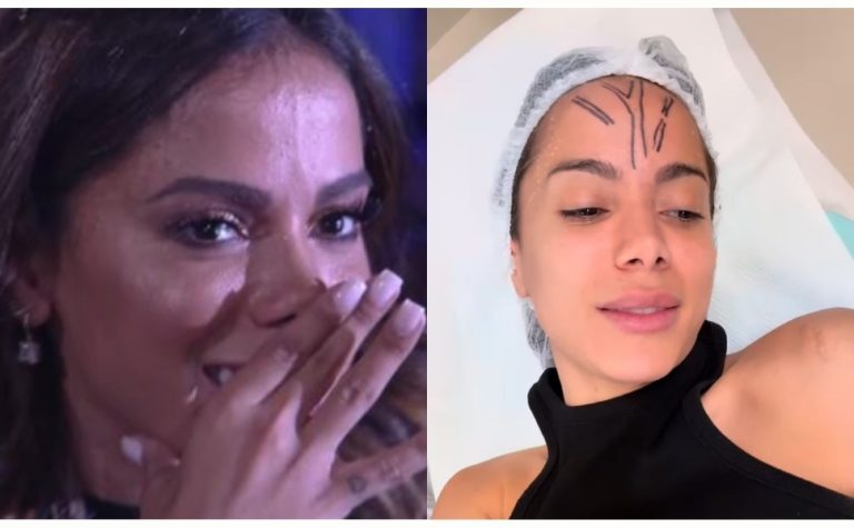 Anitta faz cirurgia para remover veia saltada na testa