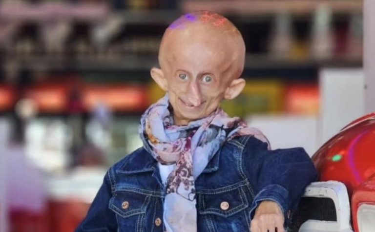 Morre Beandri Booysen, influenciadora do TikTok com doença rara, aos 19 anos