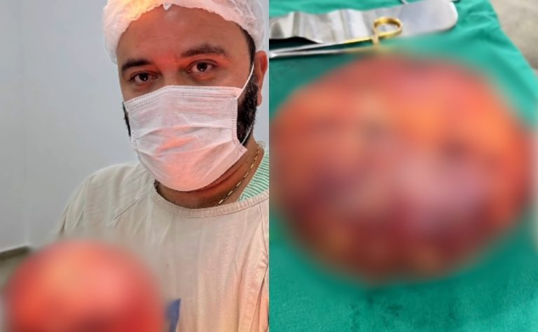 VÍDEO | Médico mostra extração de tumor gigante de quase 2 kg