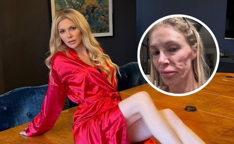Com ‘rosto derretido’, Brandi Glanville passará por cirurgia; entenda