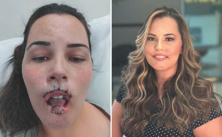Anvisa vai decidir se proíbe de vez uso de “gel da beleza”