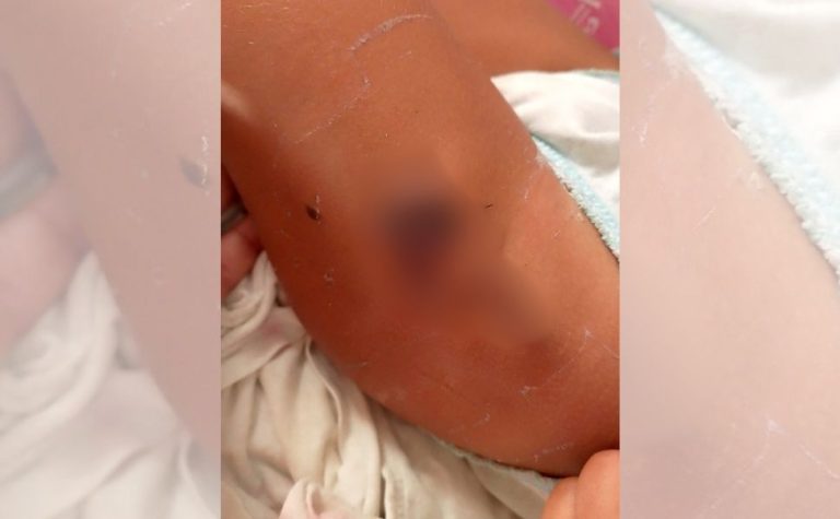 Criança de 5 anos é atacada por piranhas em lagoa no Norte do ES e leva 18 pontos