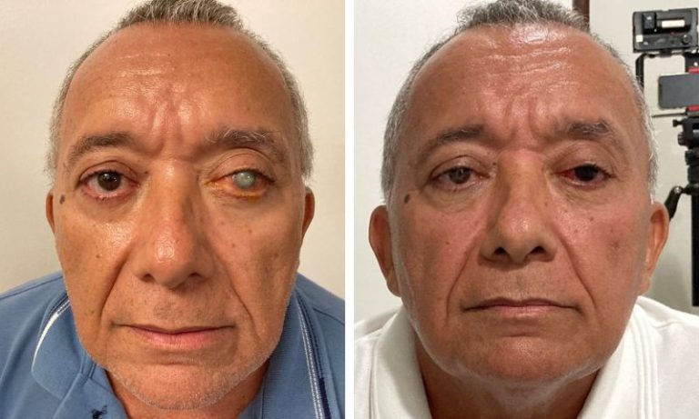 Pioneira: médica de Pernambuco revoluciona vidas com tatuagem ocular