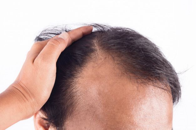 Cabelo é a preocupação da maioria dos homens
