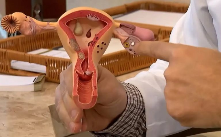 Uma em cada 10 mulheres tem sinais de endometriose