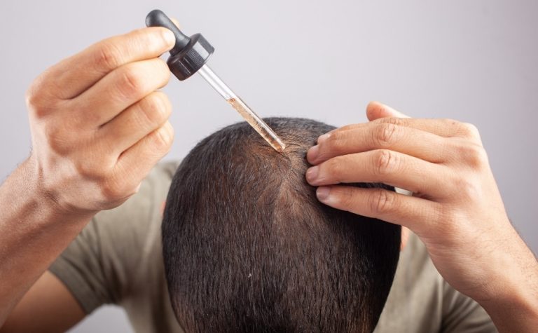 Minoxidil pode causar crescimento anormal de pelos em bebês, alerta Anvisa