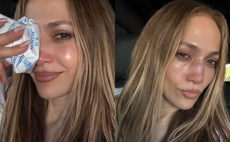 Jennifer Lopez sofre acidente em ensaio de premiação e leva pontos no rosto