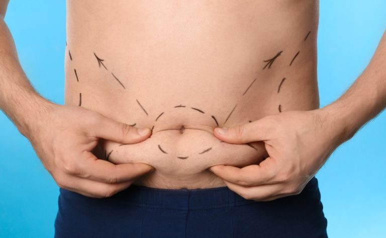 Lipo UltraHD: conheça a cirurgia para quem busca “barriga de tanquinho”