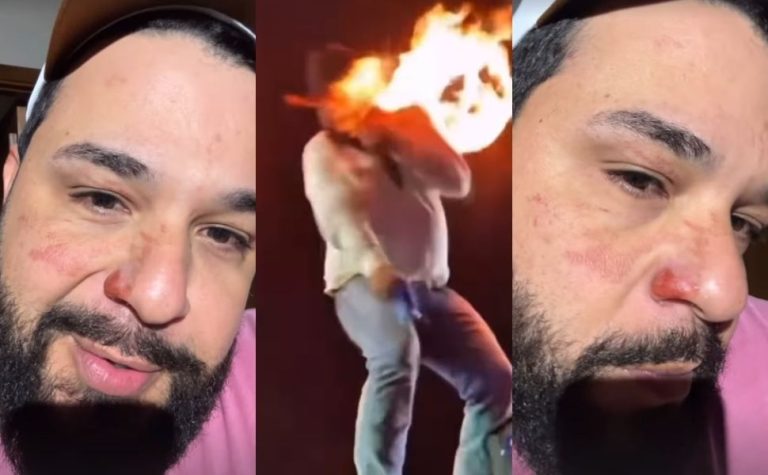 Sertanejo Léo mostra cicatrizes após ter rosto atingido por chamas durante show