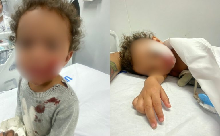 Bebê de 1 ano é atacado no rosto por pitbull no Sul do ES