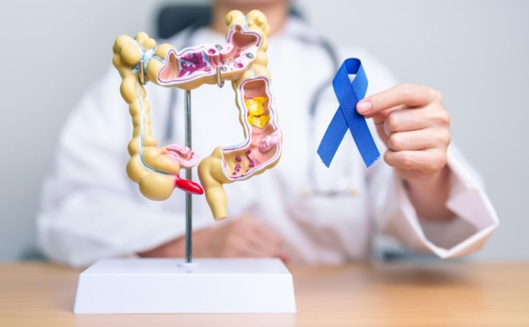 Câncer colorretal, como o de Preta Gil, cresce entre pessoas com menos de 50 anos
