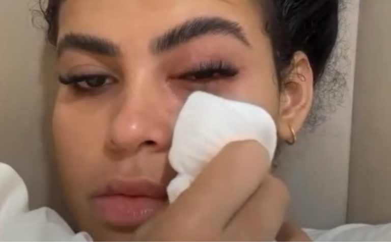 Influenciadora contrai infecção causada por mosca de banheiro na Serra